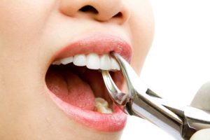 tooth-extraction-san-diego