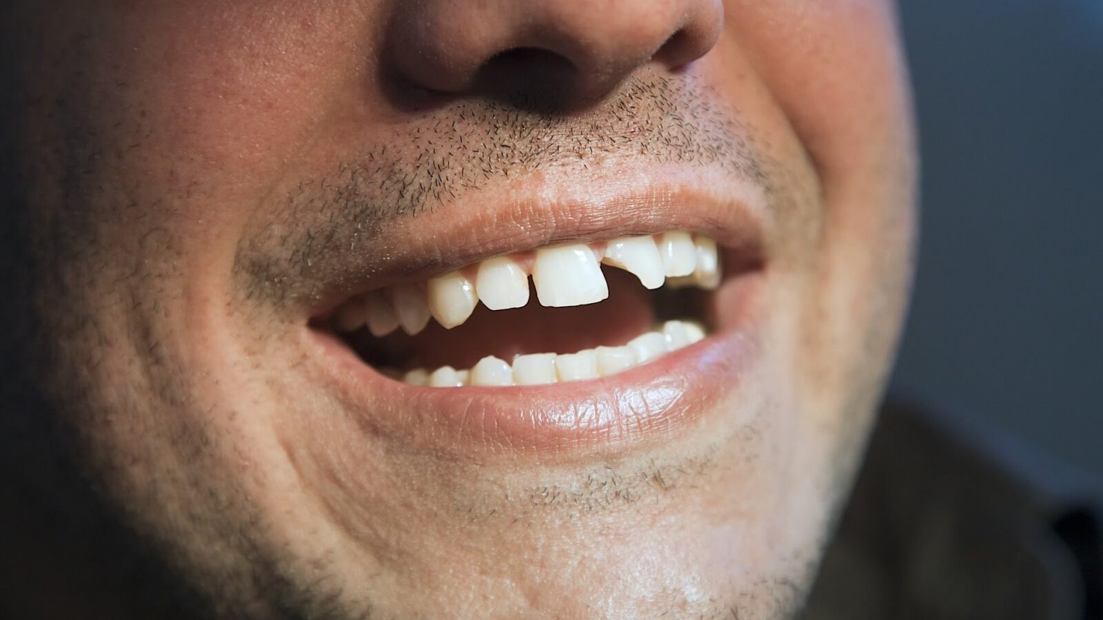 Broken Tooth? Tips On Handling Broken Teeth - Art of Smiles