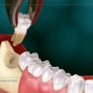 Wisdom Teeth Removal