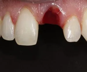 Smile transformation by Art of Smiles Pasadena, case 1