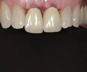 Smile transformation by Art of Smiles Pasadena, case 2