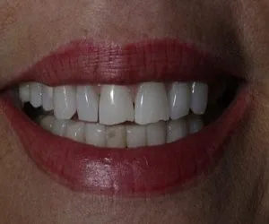 Smile transformation by Art of Smiles Pasadena, case 3
