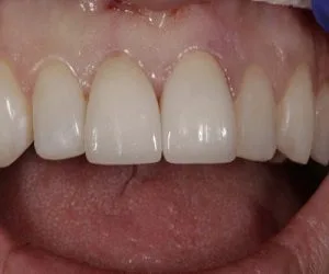 Smile transformation by Art of Smiles Pasadena, case 1