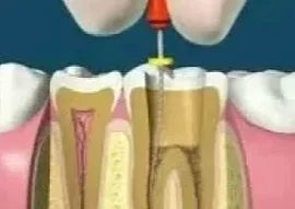 Root Canal Therapy